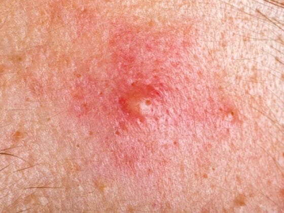 Jerawat Batu Punca Gejala dan Cara Mengatasinya