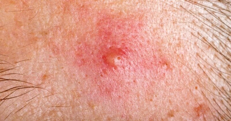 Jerawat Batu Punca Gejala dan Cara Mengatasinya